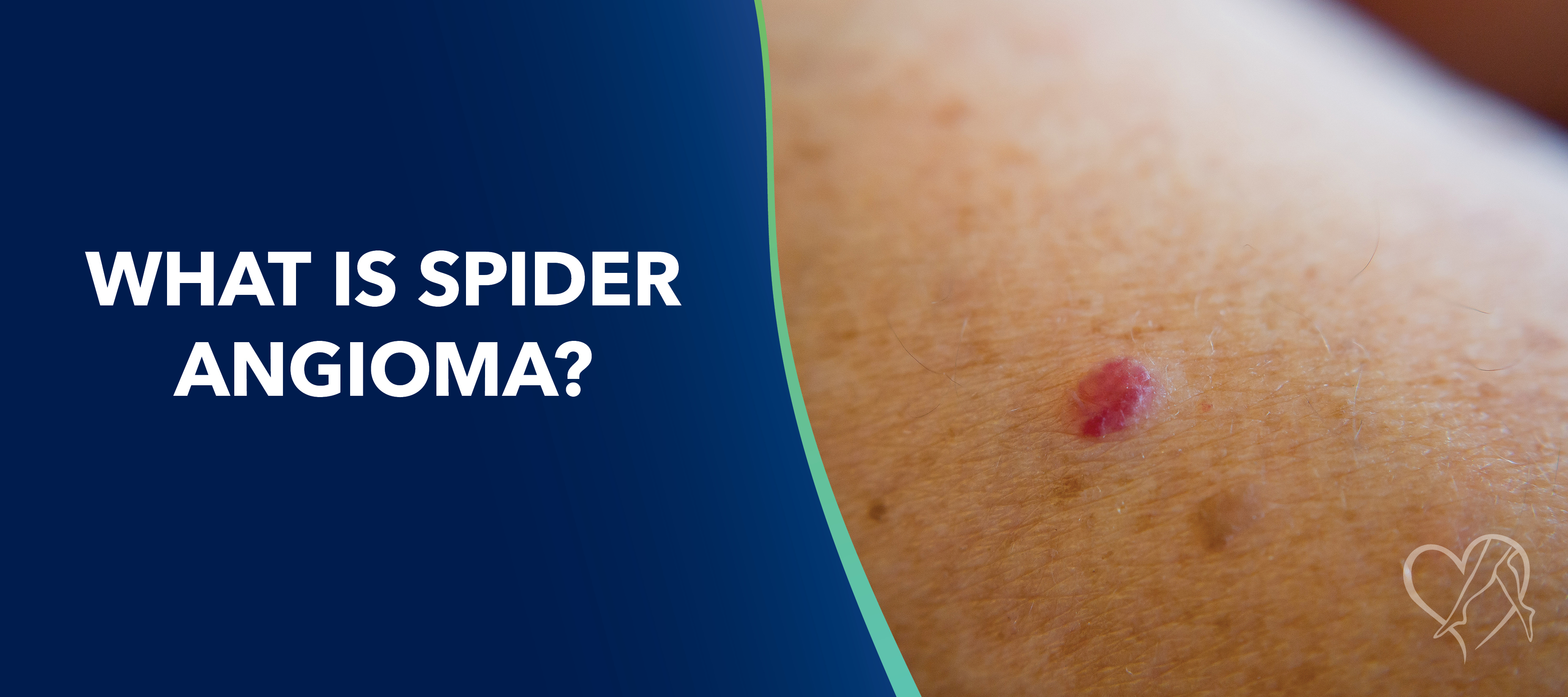 Blog What is Spider Angioma