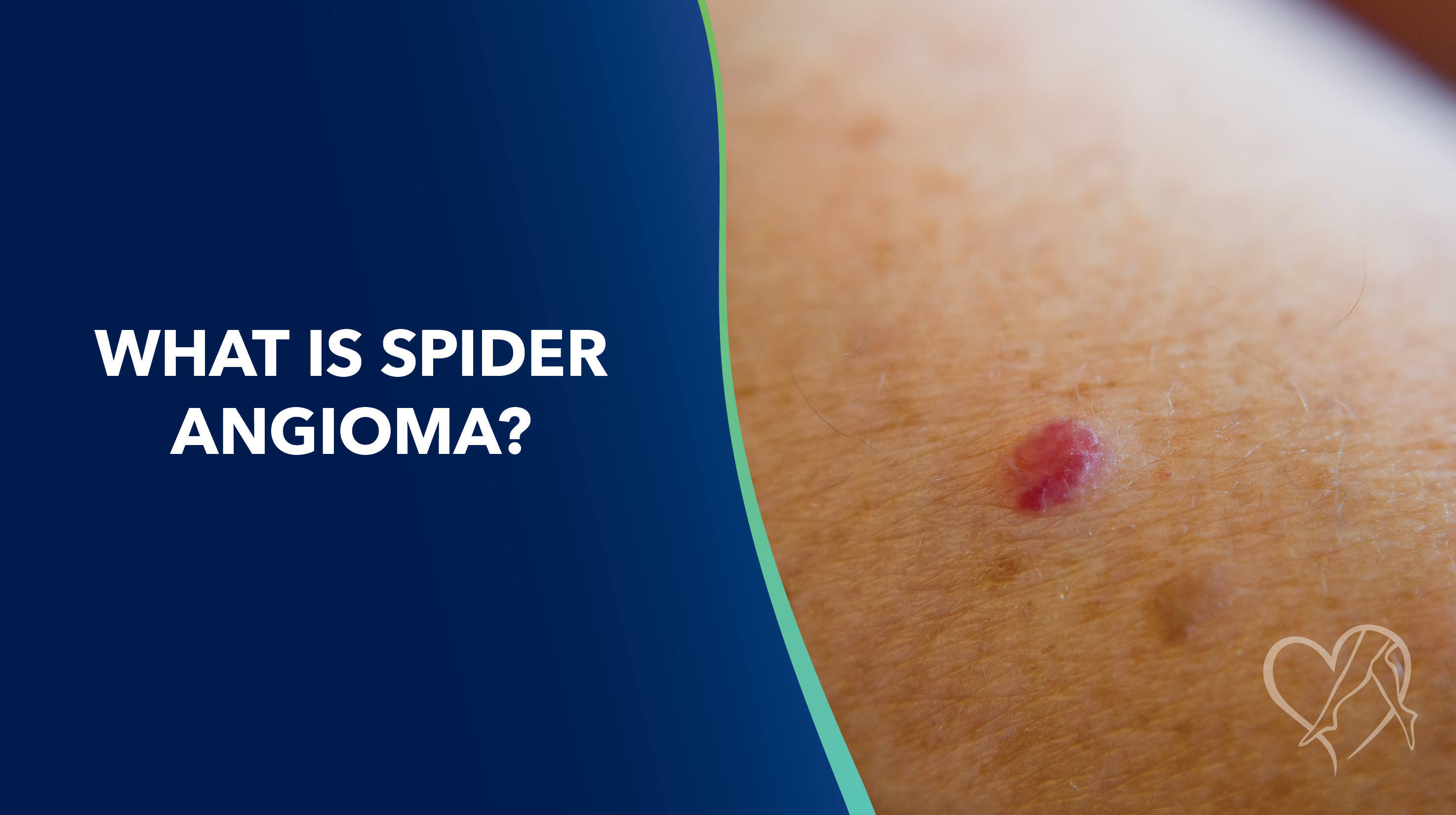 Blog What is Spider Angioma Thumbnail