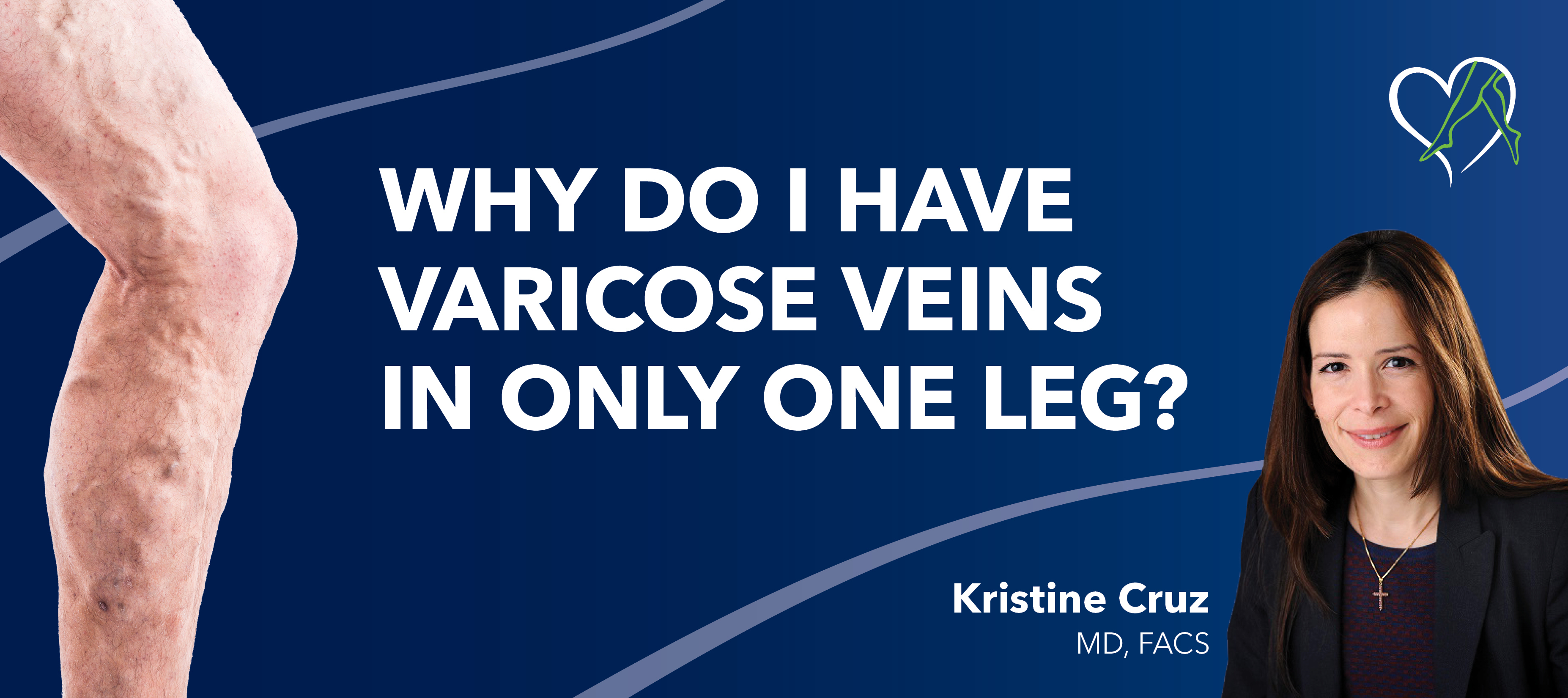 Blog Why Do I Have Varicose Veins In One Leg