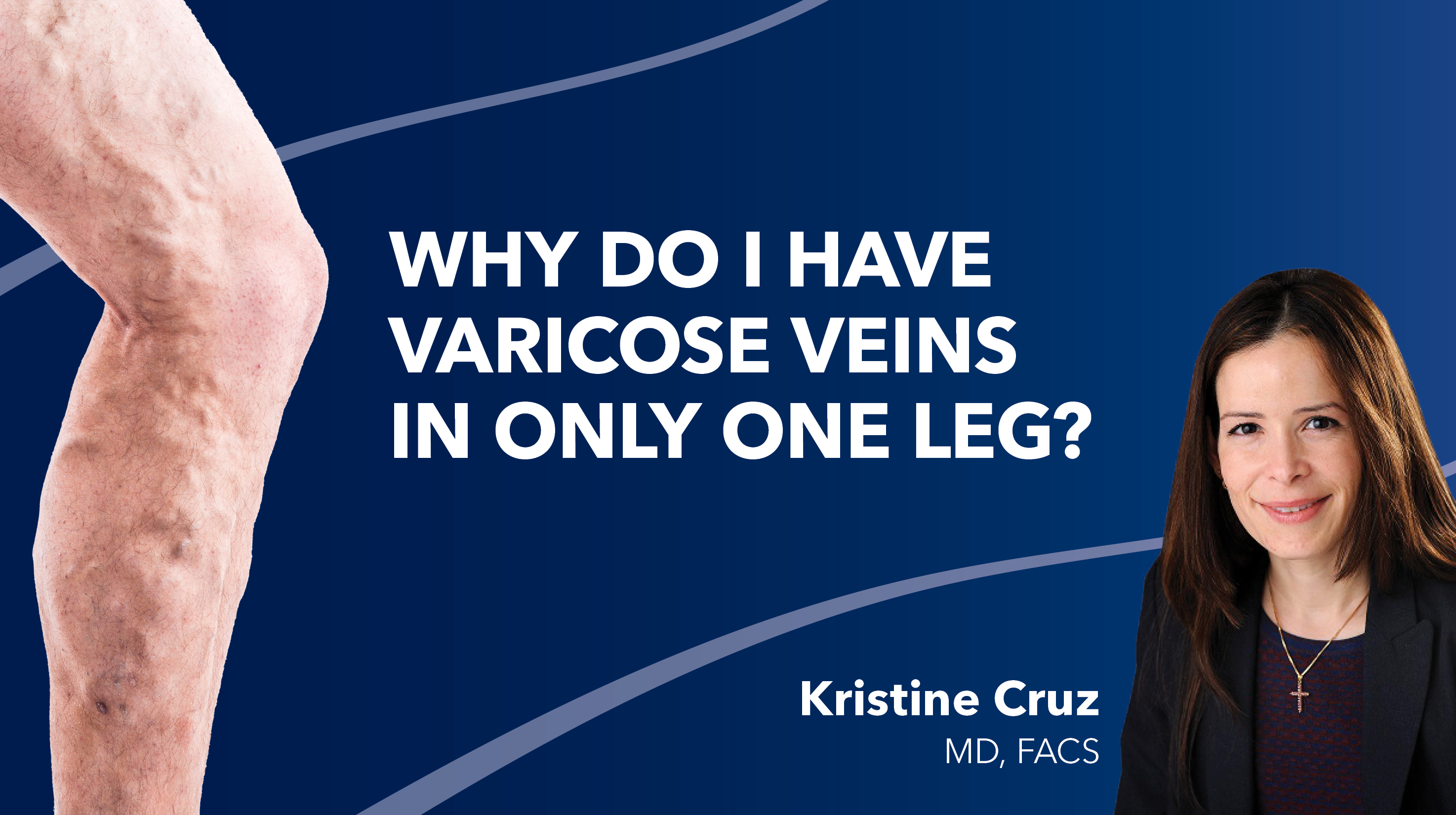Blog Why Do I Have Varicose Veins In One Leg Thumbnail
