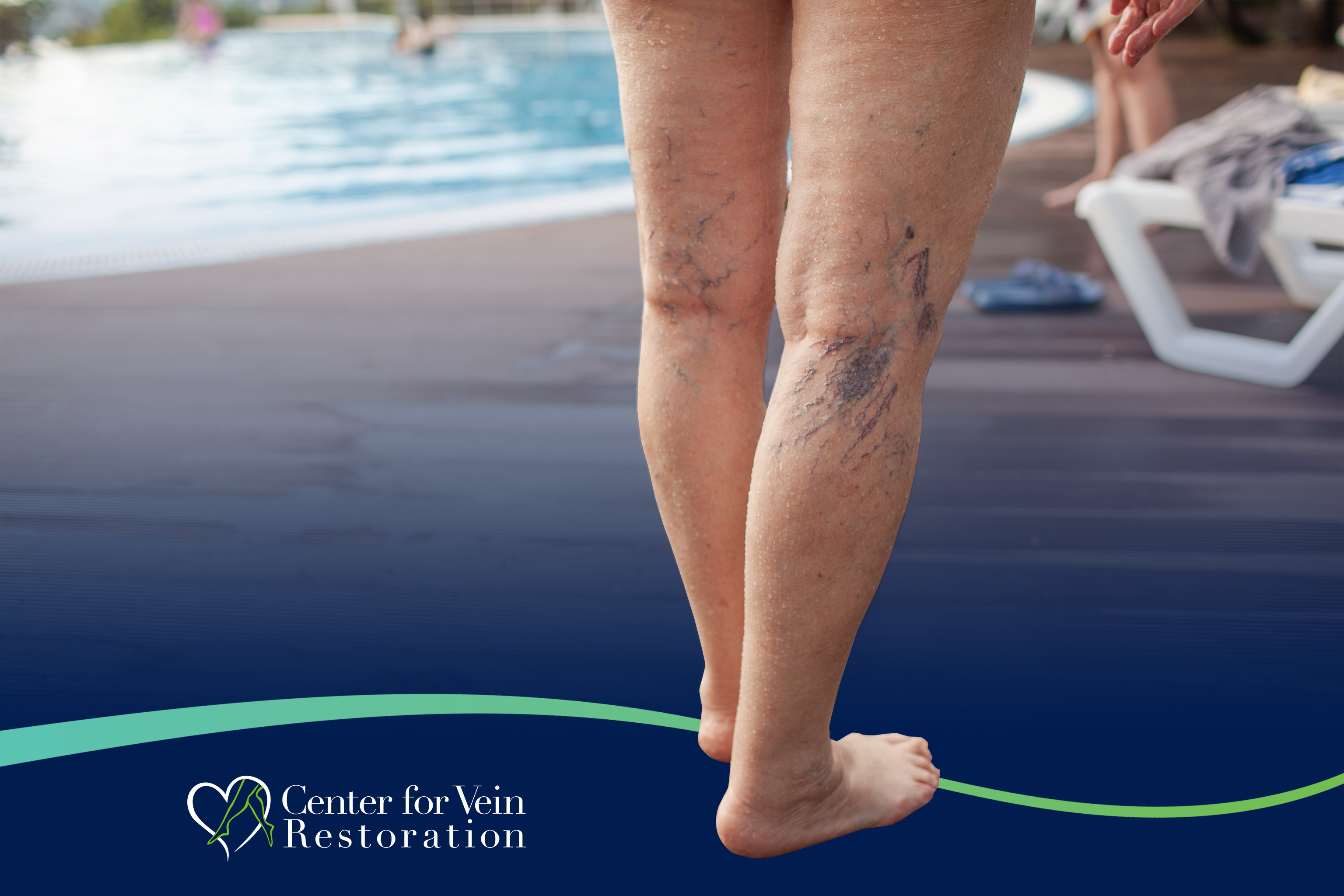 CVR Symptom CEAP1 Spider Veins New 1