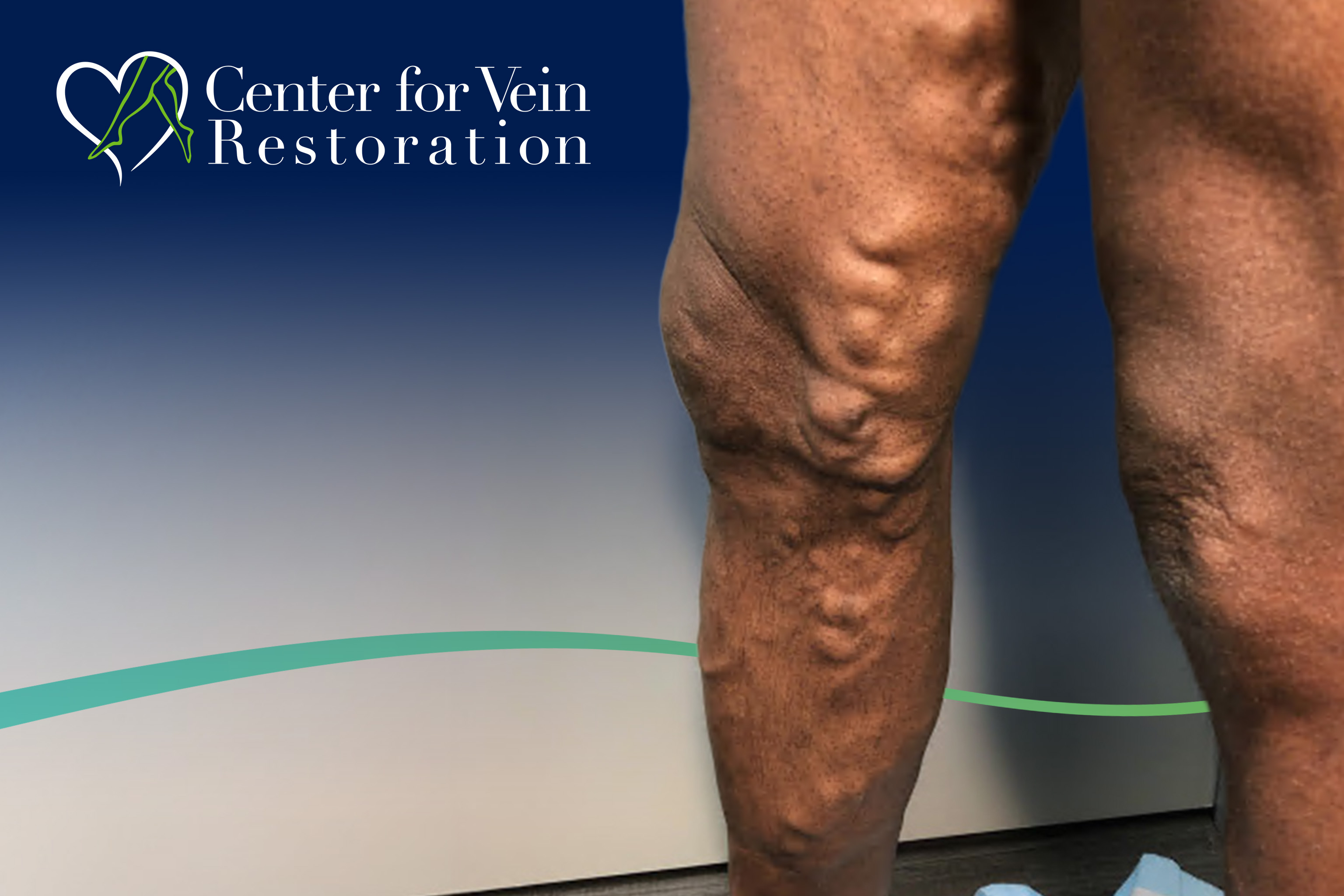 CVR Symptom CEAP2 Varicose New 1