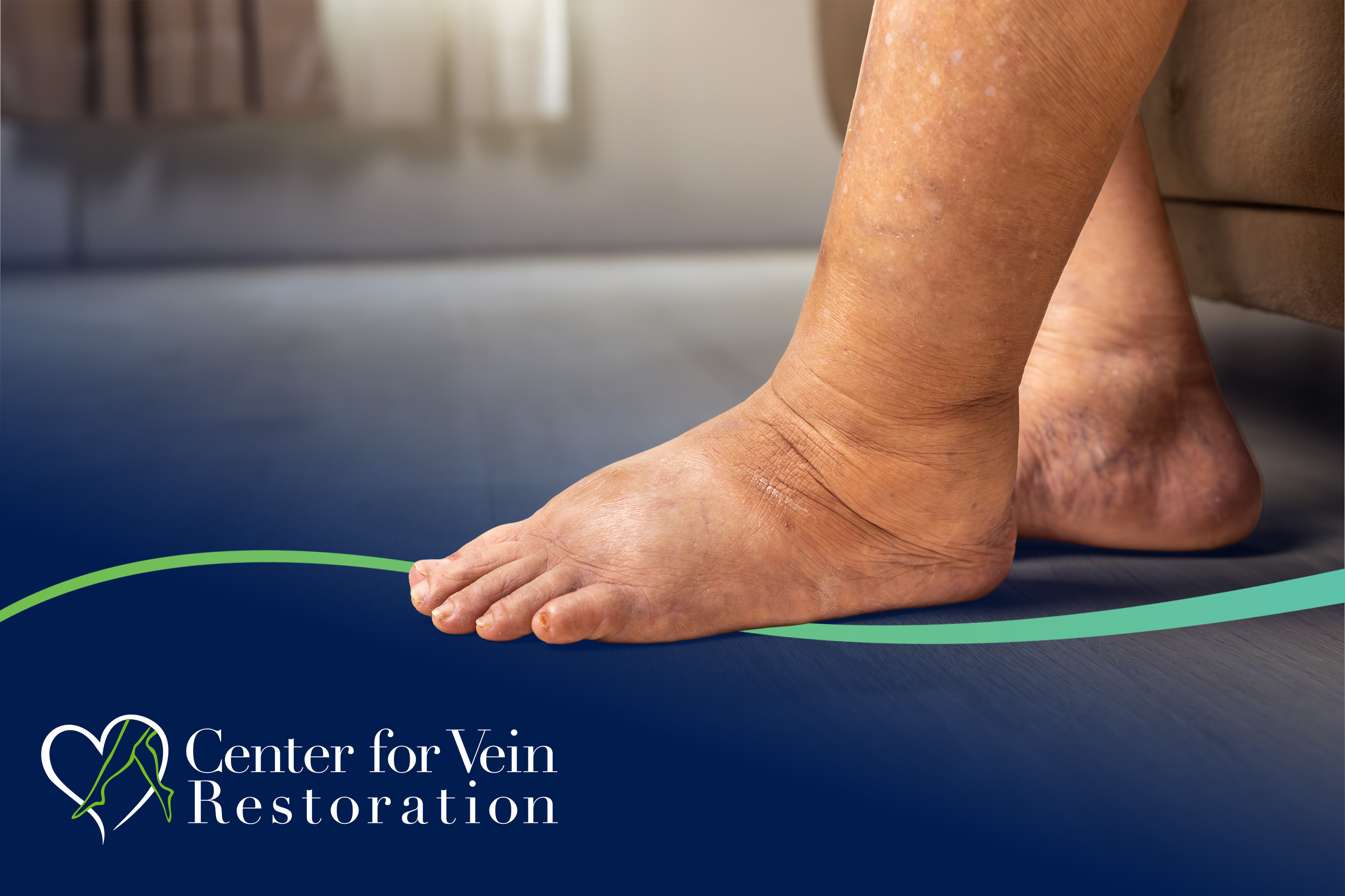 CVR Symptom CEAP3 Swelling New