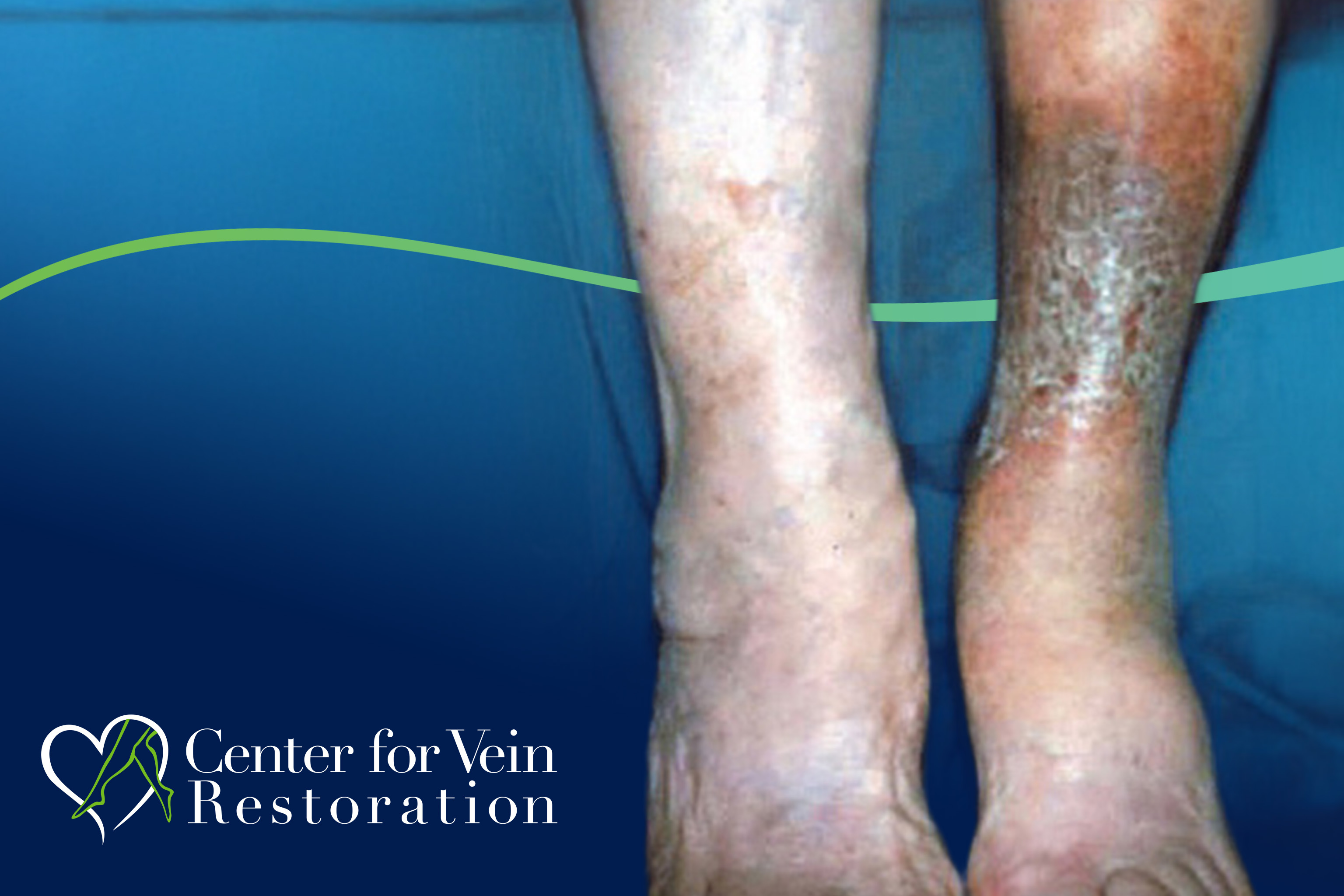 CVR Symptom CEAP4 Discoloration New