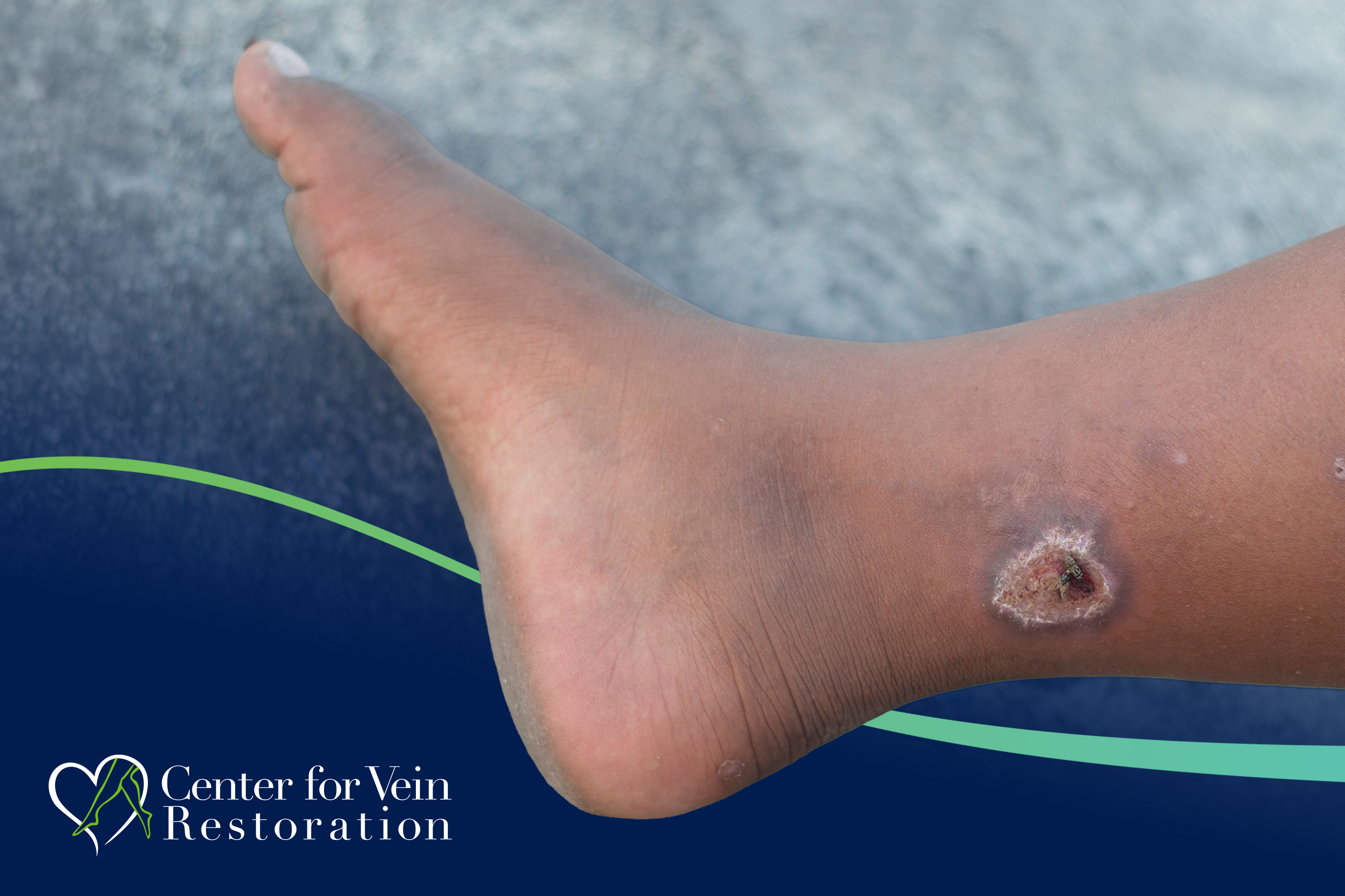 CVR Symptom CEAP6 Ulcer New