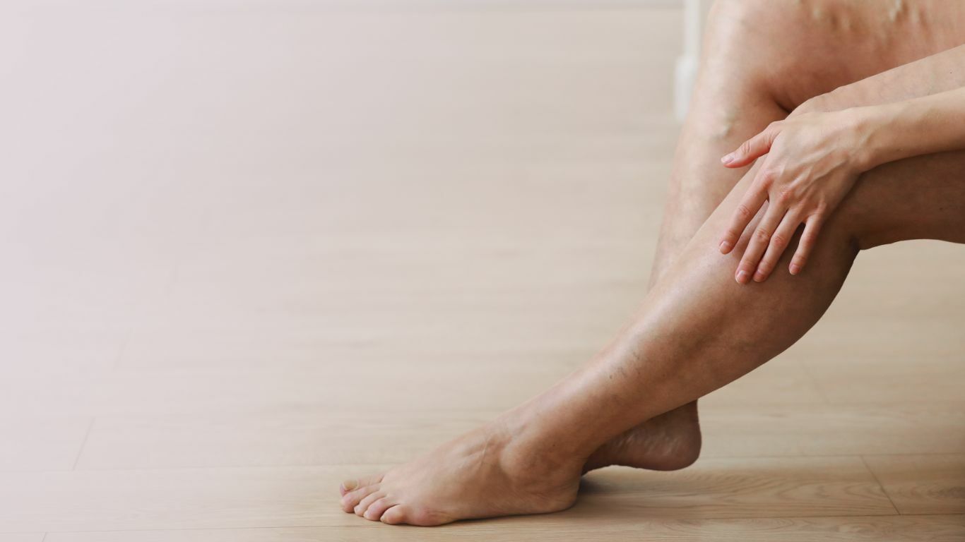 Do Spider Veins Mean Blood Clots