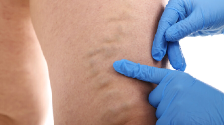 Varicose Veins: Causes, Symptoms & Treatment | In The Know