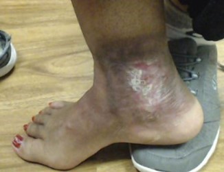 Dr Pappas Varicose veins and Venous Ulcer After 2