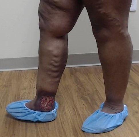 Dr Pappas Varicose veins and Venous Ulcer Before 1