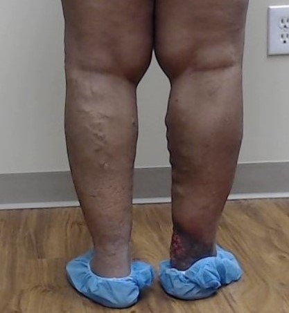 Dr Pappas Varicose veins and Venous Ulcer Before 2
