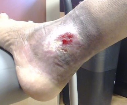 Dr Pappas Varicose veins and Venous Ulcer During 2