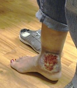 Dr Pappas Varicose veins and Venous Ulcer During