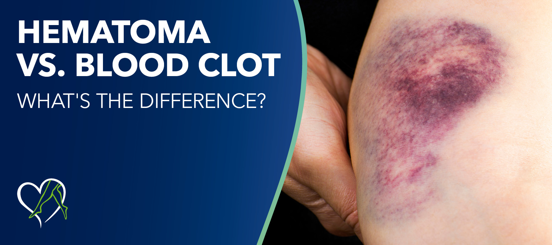 Hematoma Vs Blood Clot