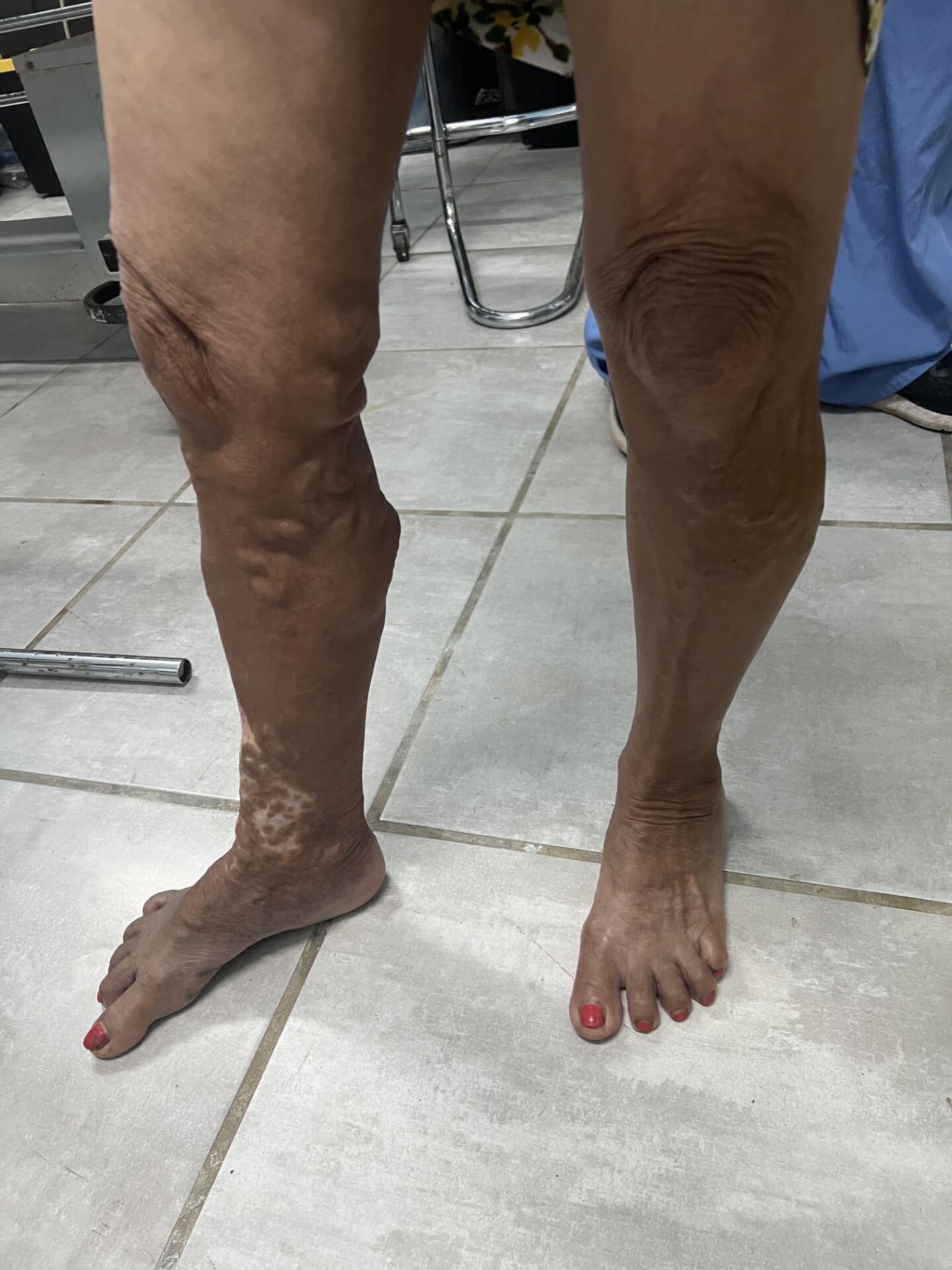 Hondurus Varicose Veins