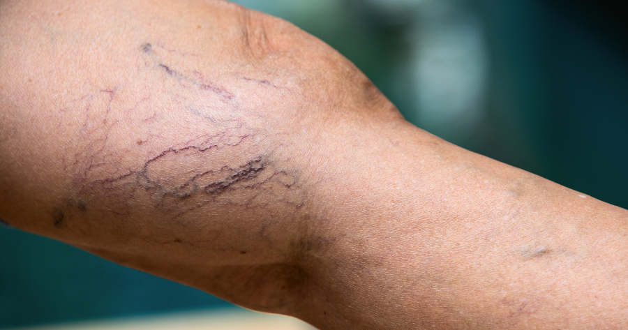 How Do I Know If I Have a Blood Clot in My Varicose Vein