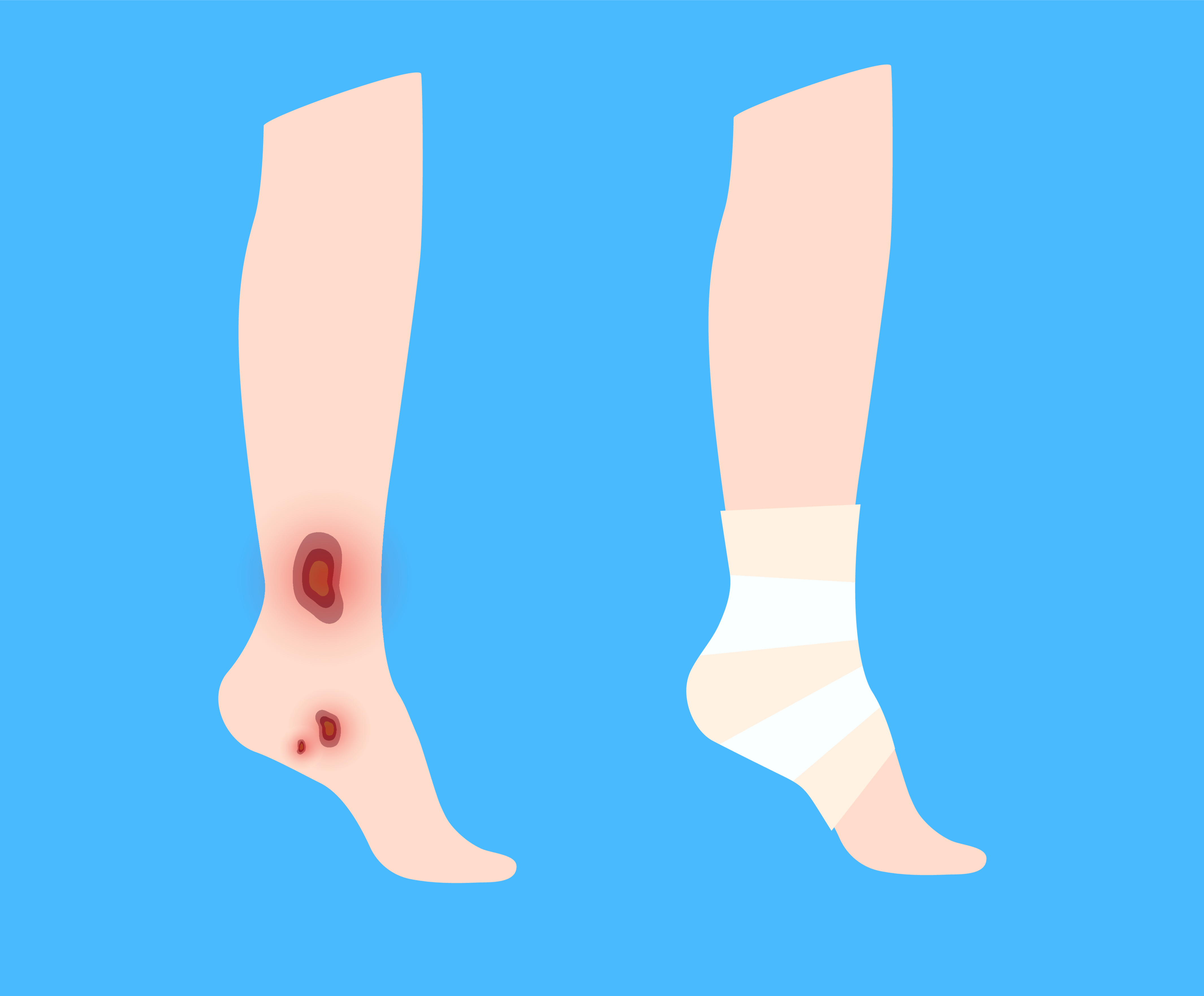 How Do I Know If My Leg Sore Is a Leg Ulcer?