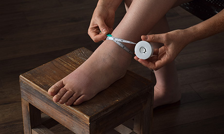 Image The Most Common Causes of Leg Swelling Thumbnail