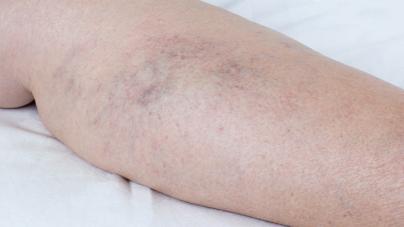 https://cdn.craft.cloud/4f7c8d17-0c96-40cd-89a4-3f6a0150b271/assets/images/Should-I-See-a-Vein-Specialist-for-Superficial-Thrombophlebitis.jpg?width=360&quality=80&fit=contain&s=Q1S_rCHCHvJRMMNZAwCKH2vGRsrH-rpIHbhaDjzp9pI