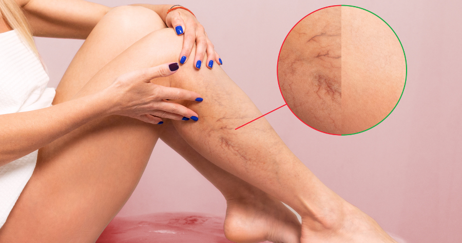 Spider-Vein-Free-Legs-Can-Be-