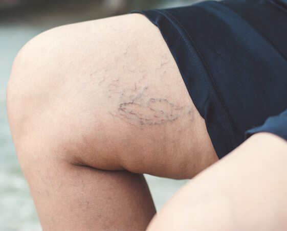 Spider veins image