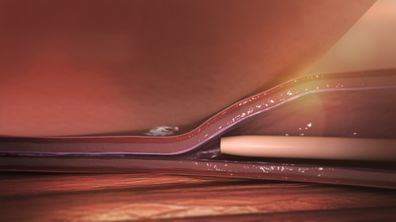 Vena Seal Internal Compression 2 1