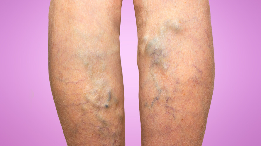 Visual signs of Varicose Veins