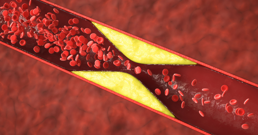 What Are the First Signs of a Blood Clot in Foot