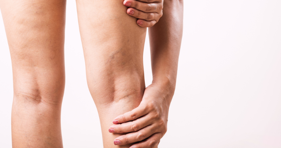 Why Do Spider Veins Appear 1