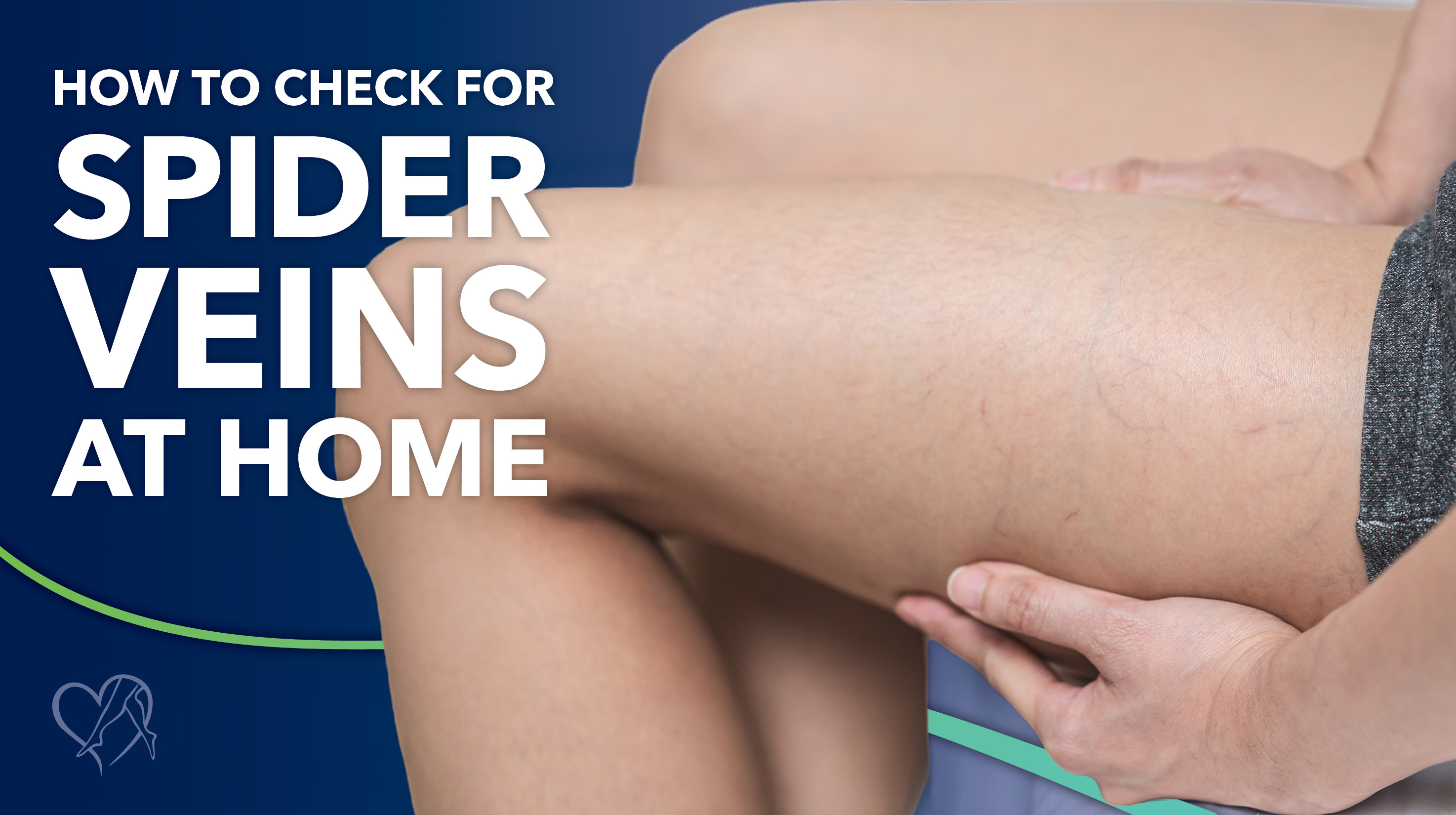 Blog how to check for spider veins at home Thumbnail