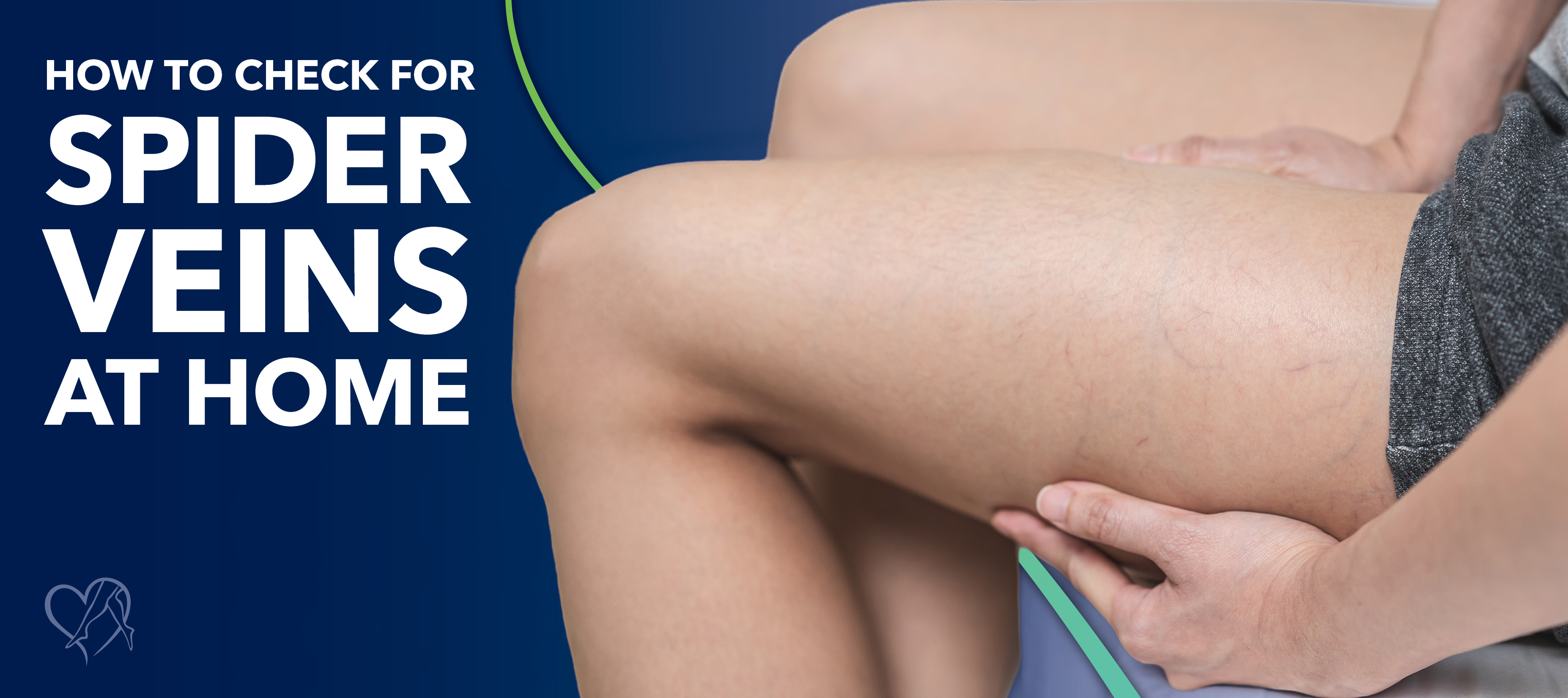 Blog how to check for spider veins at home