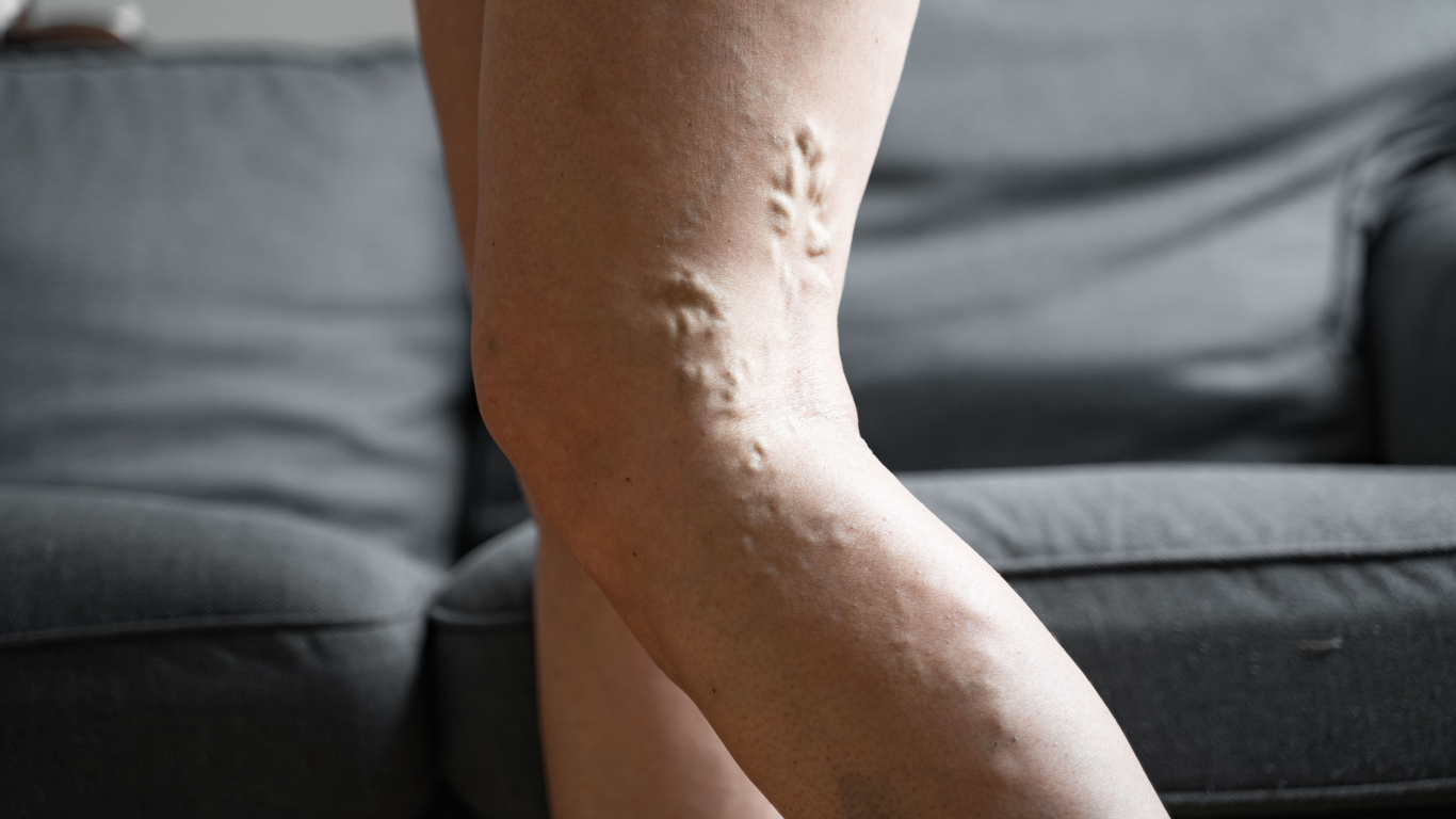 How do I fix varicose veins