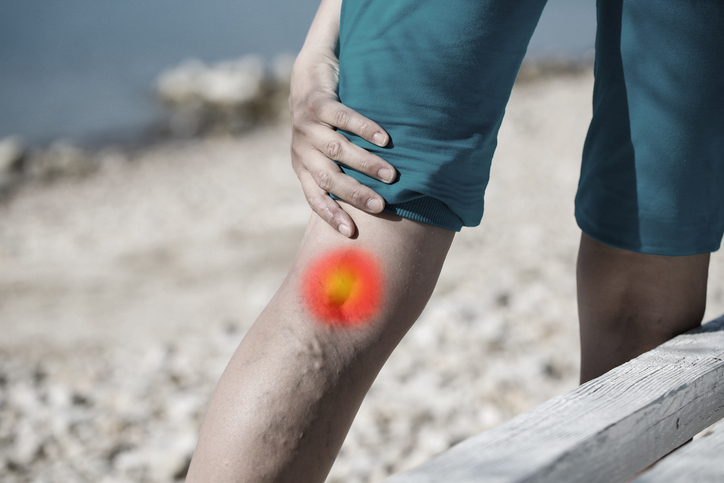 Leg with bulging veins and pain illustration