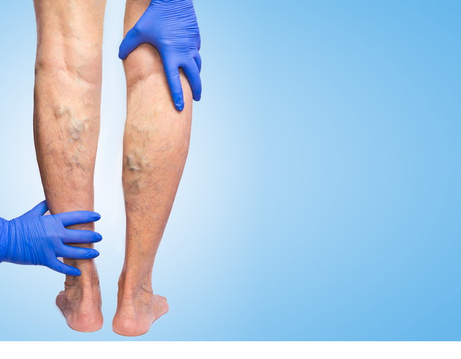 Lower limb vascular examination