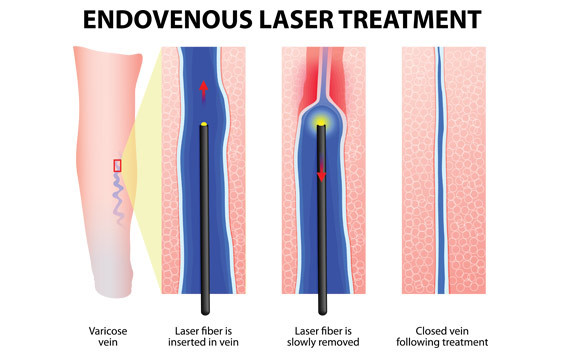 Laser