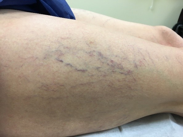 Spider veins before treatment