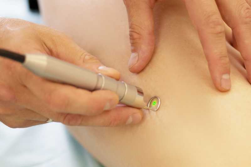 Spider veins medical laser surgery picture id537854915