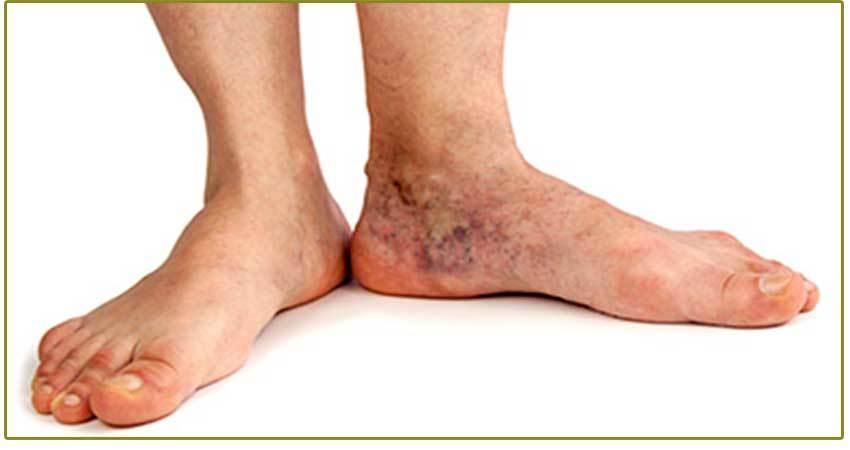 Symptoms of venous insufficiency