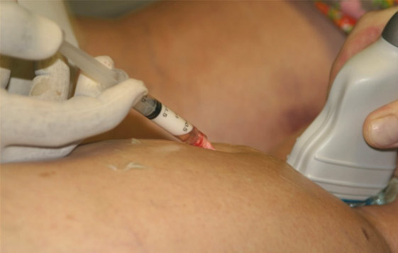 Ultrasound sclero