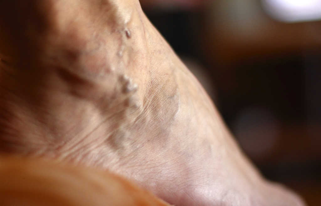 Varicose veins heal