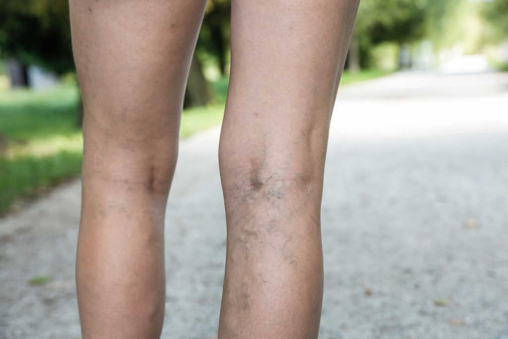 Varicose veins height