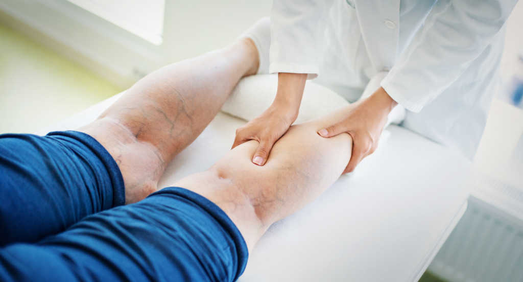 Varicose veins legs