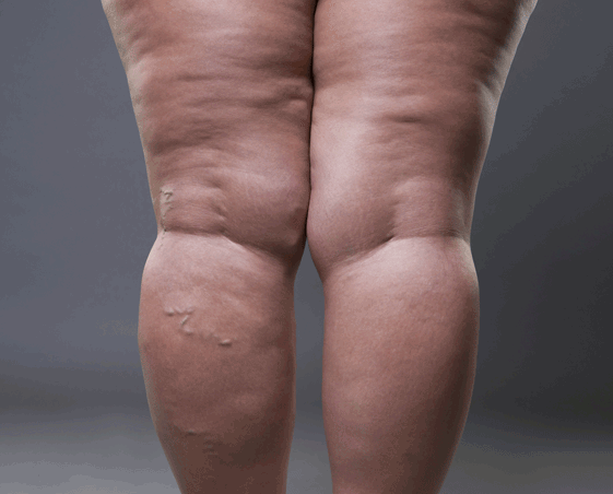 Venous insufficiency 2