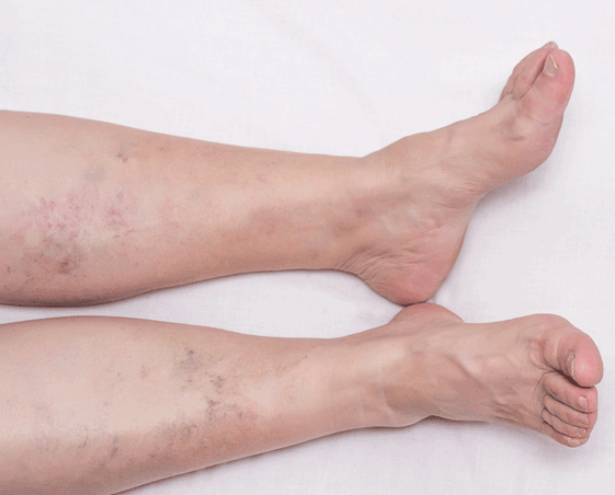 Venous insufficiency