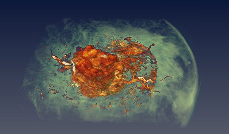 3D mammography CSIRO