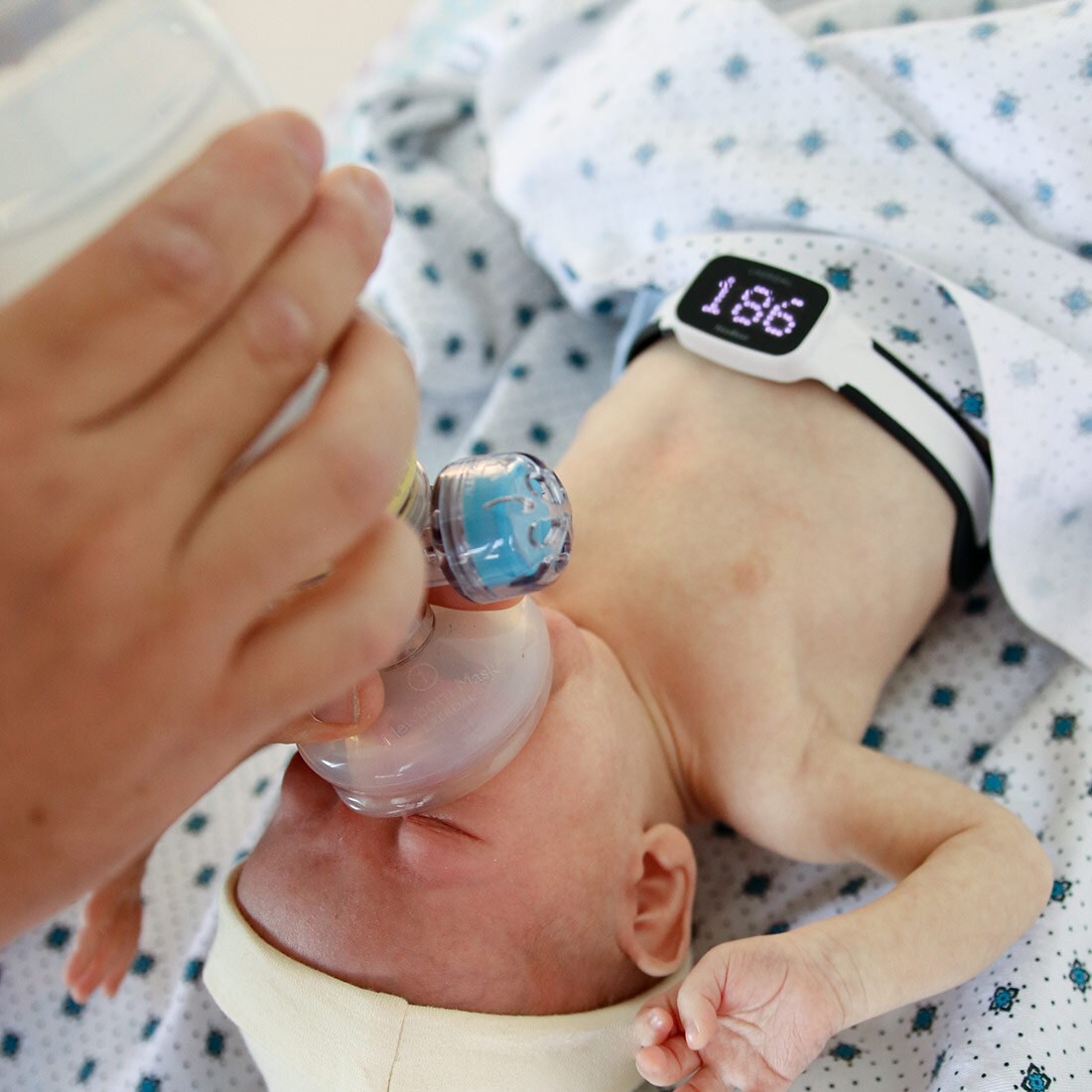 Bildet viser en nyfødt baby som blir gitt oksygen via en håndholdt inhalator. Barnet ser ellers frisk ut, og har på seg en hjertemonitor som tydelig viser tallet 186.