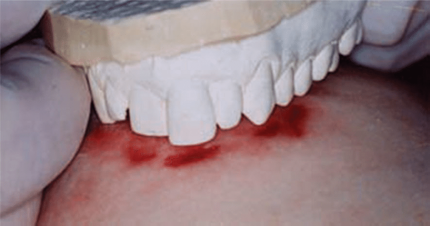 Bite Mark Comparison | Death Penalty Information Center