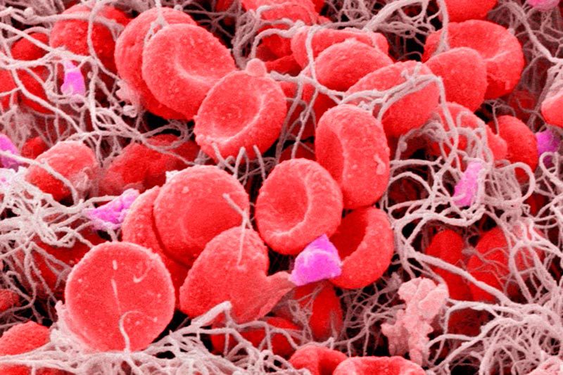 Programs pipeline hemophilia thumb